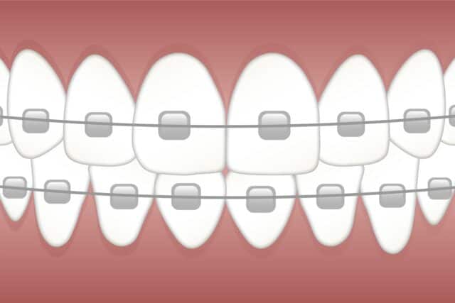 aparat ortodontyczny darmowy obraz z pixabay